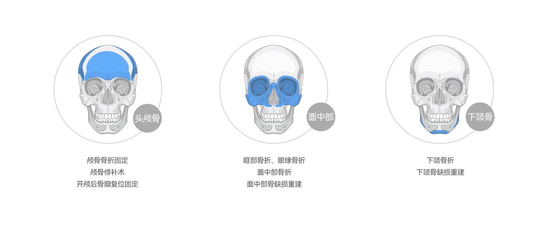 聚醚醚酮顱頜面固定板應用