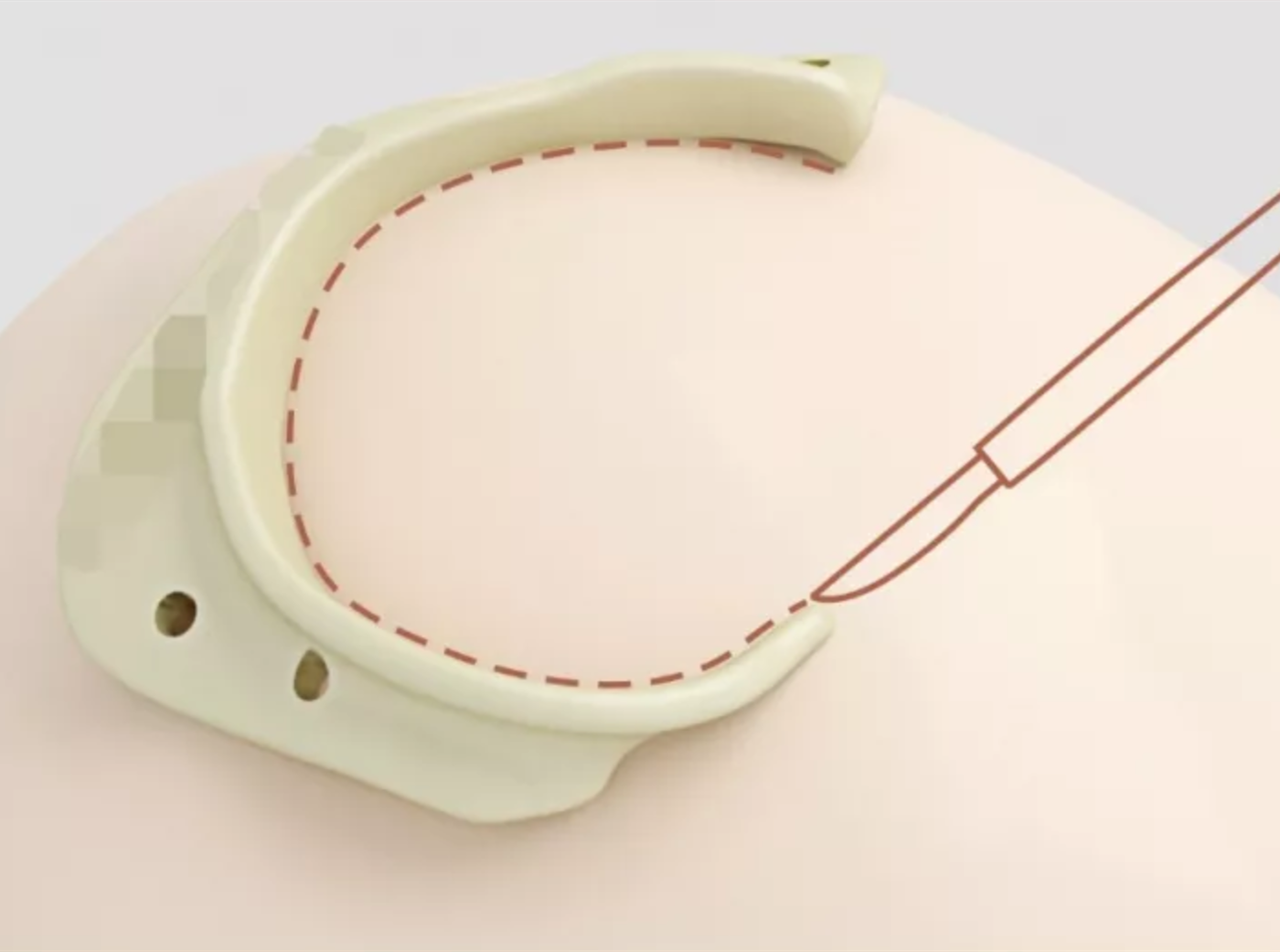 當顱骨修復遇上3D手術導板，完美m(xù)atch！