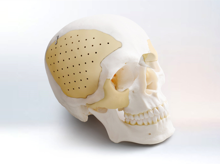 “腦洞”大開？顱骨修補幫你忙！