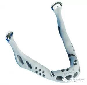 3D打印技術在骨科個體化治療方面的優(yōu)勢和應用